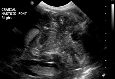 mastoid coronal normal cerebell